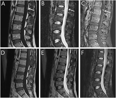 Impact of the Extent of Surgical Resection on Patients With Intradural Extramedullary Bronchogenic Cysts: A Retrospective Institutional Experience and Review of the Literature